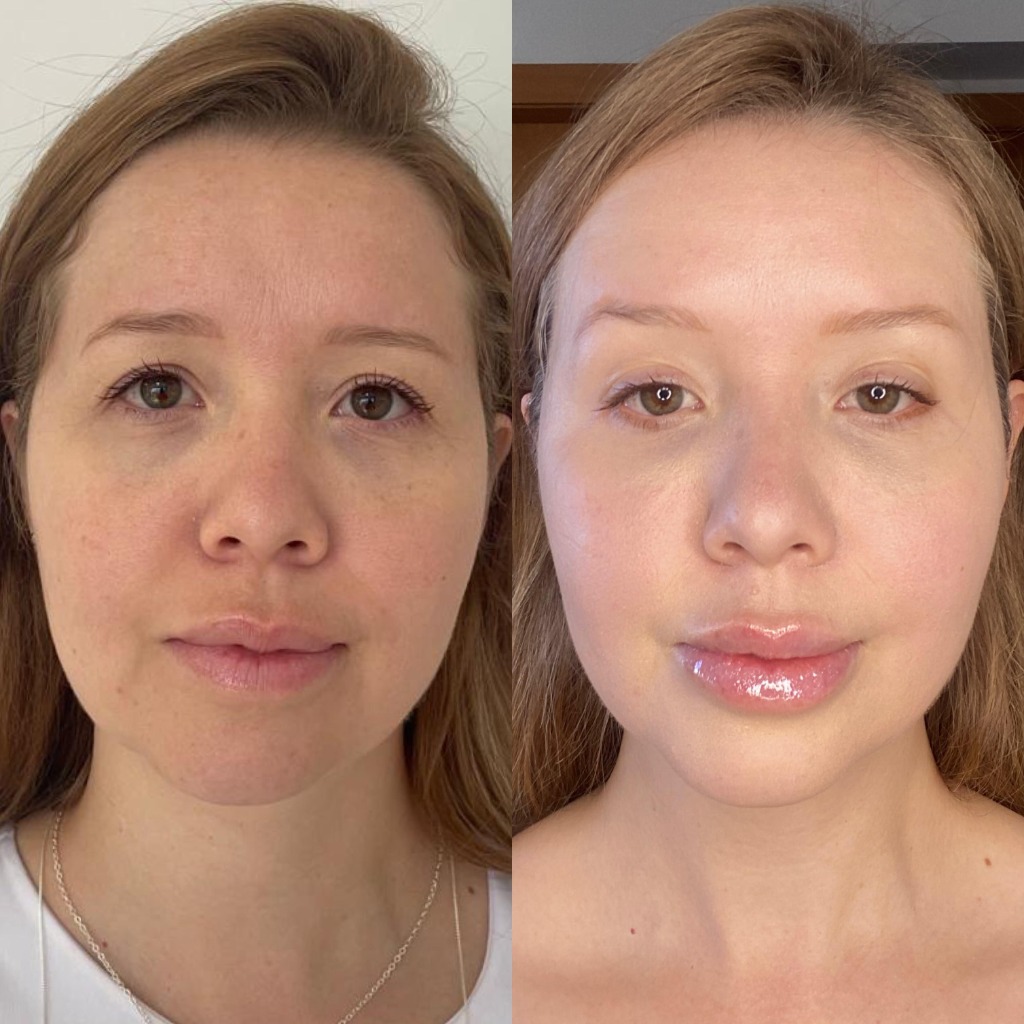 Antes e Depois de Harmonização Facial e Rejuvenescimento - Dra. Danielly Lopes @danylopes.pele